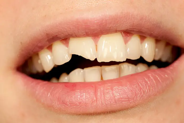 شکستگی دندان در فک بالا عامل اصلی تیر کشیدن دندان 74777777