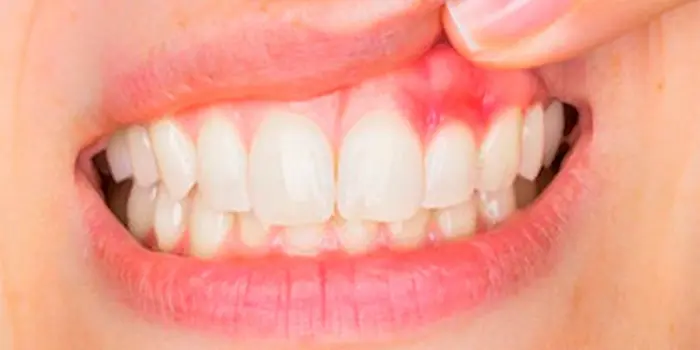 بیمار مبتلا به عفونت یا ورم لثه، یکی از علائم تیر کشیدن دندان 4584687