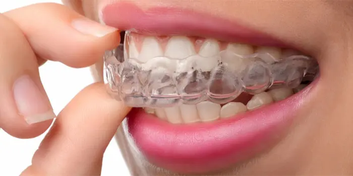 گارد دهان برای درمان دندان قروچه 65468746