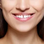 علت فاصله افتادن بین دندان ها چیست؟ 🦷| درمان 🩺| عوارض 🔴|