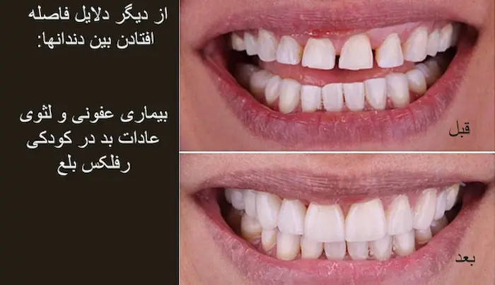 درمان قبل و بعد فاصله بین دندان در بیمار 5694