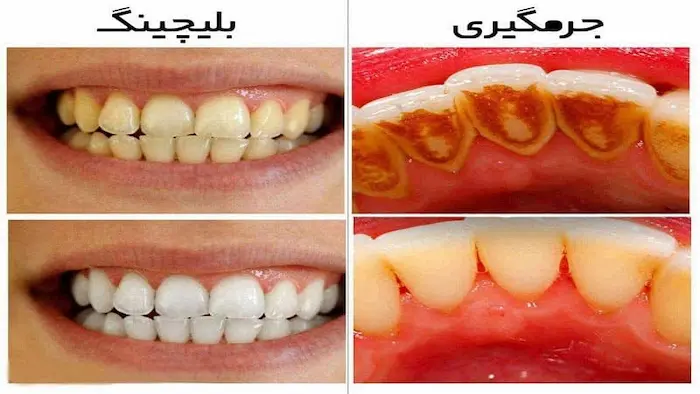 تفاوت ظاهری بلیچینگ و جرم گیری دندان 45864