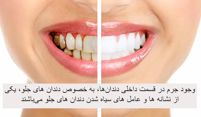 قبل و بعد جرم گیری دندان 748457