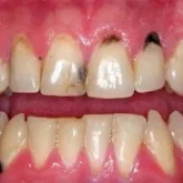 همه چیز در مورد دلایل سیاه شدن دندان 🦷| 9 علت | راه های درمان✅
