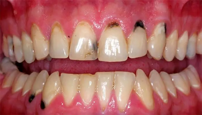 دندان های سیاه شده بیمار در فک بالا 454456