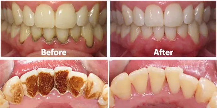عکس قبل و بعد جرم گیری دندان 41568