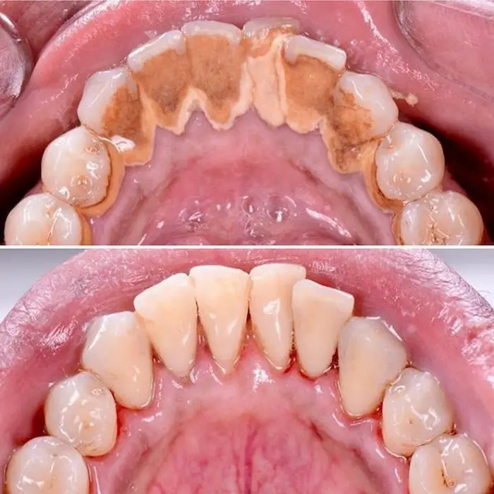 عکس قبل و بعد جرم گیری دندان 5864