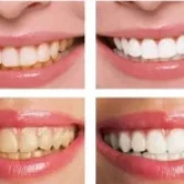 فرق بلیچینگ و جرم گیری دندان در چیست؟ 🔎| کدام بهتر است؟