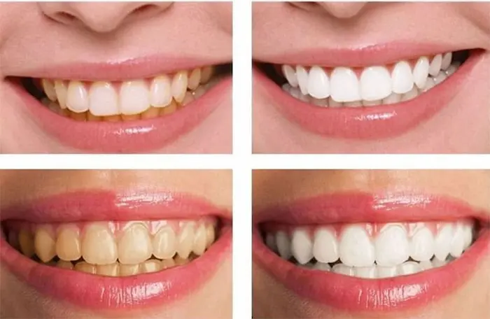 عکس لبخند قبل و بعد جرم گیری و بلیچینگ دندان 58145