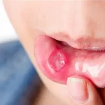 آفت دهان چیست؟👄| علائم❌+انواع آفت👅| دلایل✔️+درمان🟢