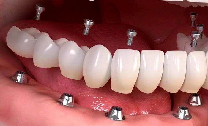 ایمپلنت دندان در گرگان 638438763