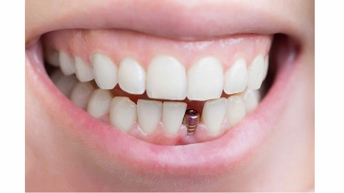 پیچ ایمپلنت در دهان دندان های جلویی فک پایین 63886843