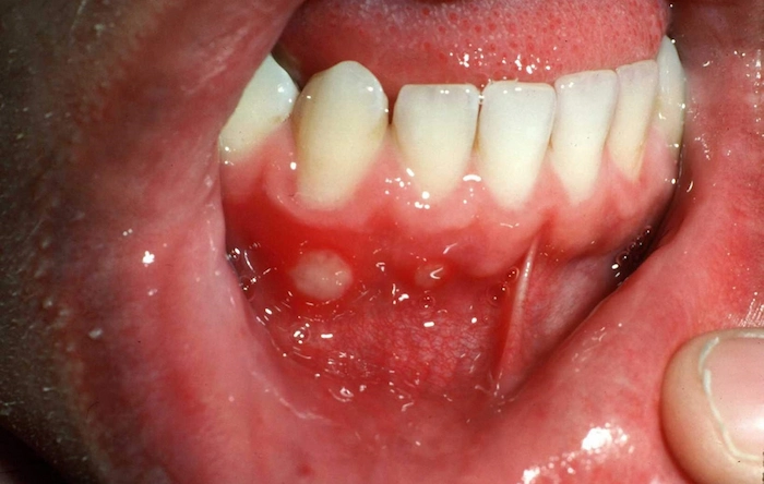 آفت دهانی از انواع زخم های دهانی 41354736878