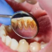 تاثیر اسید معده بر دندان ها 🦷| پیشگیری ✳️