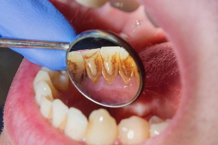 پوسیدگی دندان ها بر اثر تاثیرات اسید معده 41538743857
