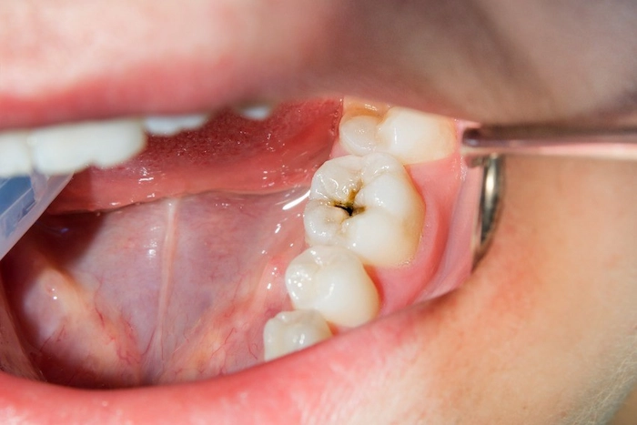 پوسیدگی دندان بر اثر اسید معده بالا 41368473878