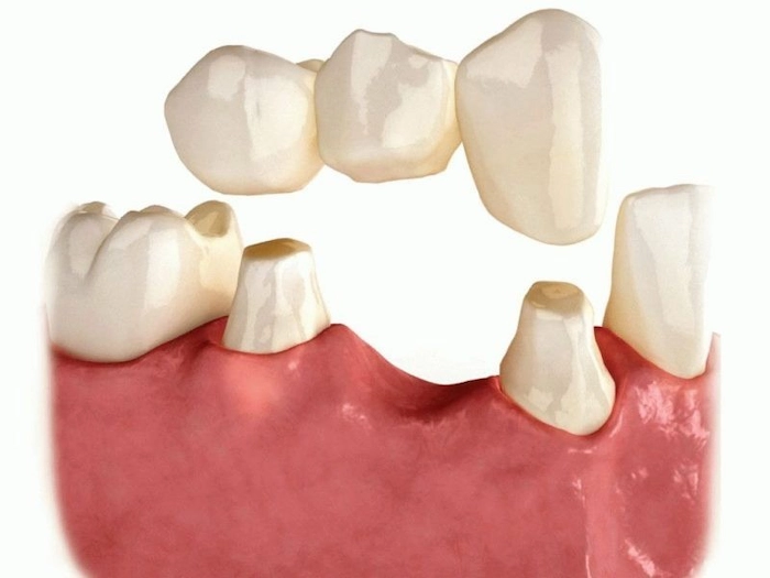 بریج دندان در دهان 534537483