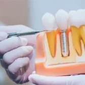 تأثیر پوکی استخوان بر کاشت ایمپلنت دندان 🦷🦴