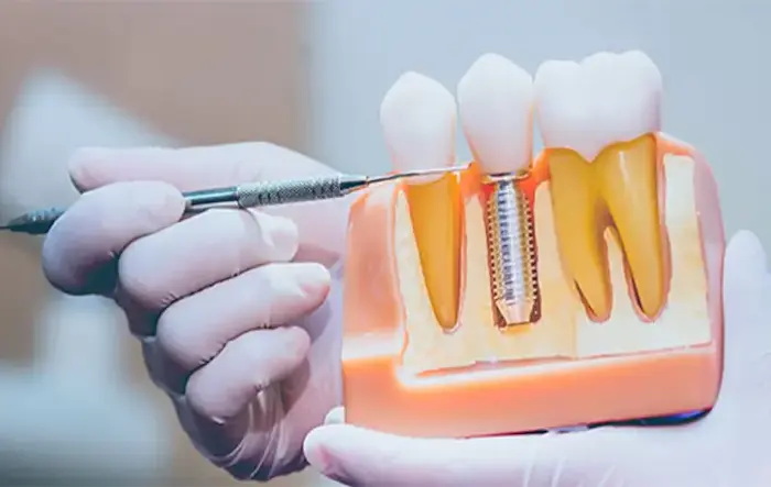 تأثیر پوکی استخوان بر کاشت ایمپلنت دندان 34325334