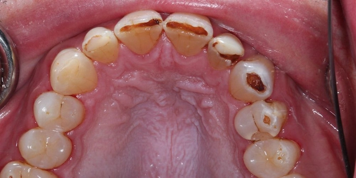 پوسیدگی و از بین رفتن دندان ها بر اثر اسید معده 4137438736
