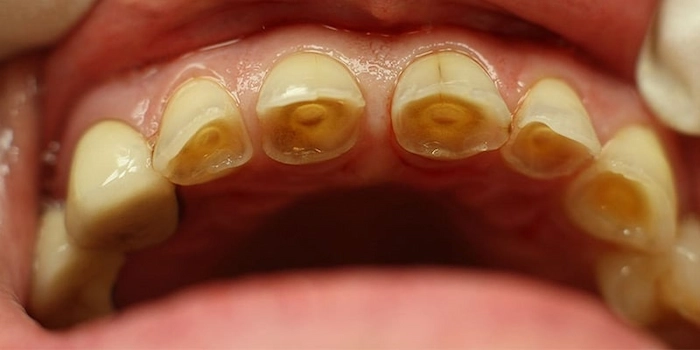 تاثیرات دلخراش اسید معده بر دندان ها 4153874374