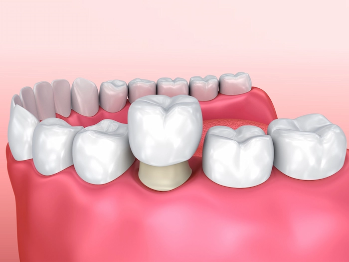 دلایل مختلف درد دندان روکش شده 38438453413