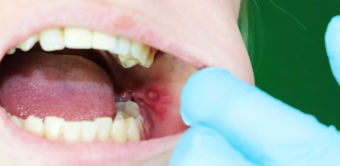 انواع زخم های دهانی و تشخیص آنها 41657486768