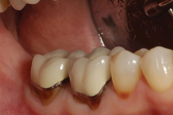 عفونت دندان از علت های درد آن 364737834