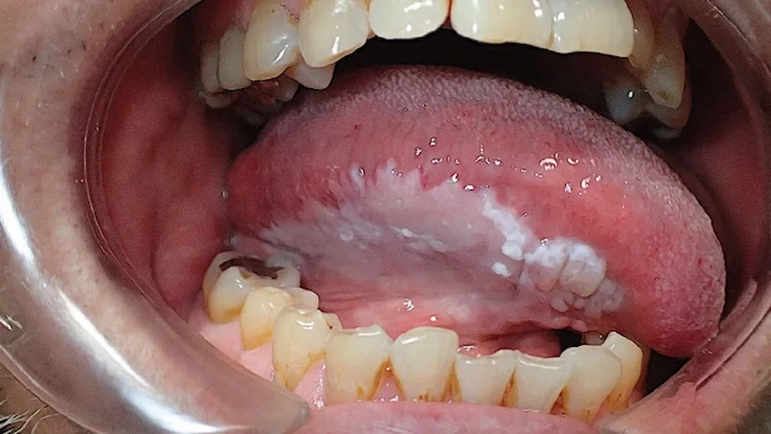لکوپلاکی در دهان از انواع آفت های دهانی 418574873