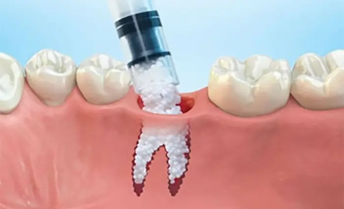 رابطه پوکی استخوان و کاشت ایمپلنت دندان 375834856