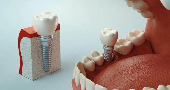 پوکی استخوان و کاشت ایمپلنت دندان 454367467