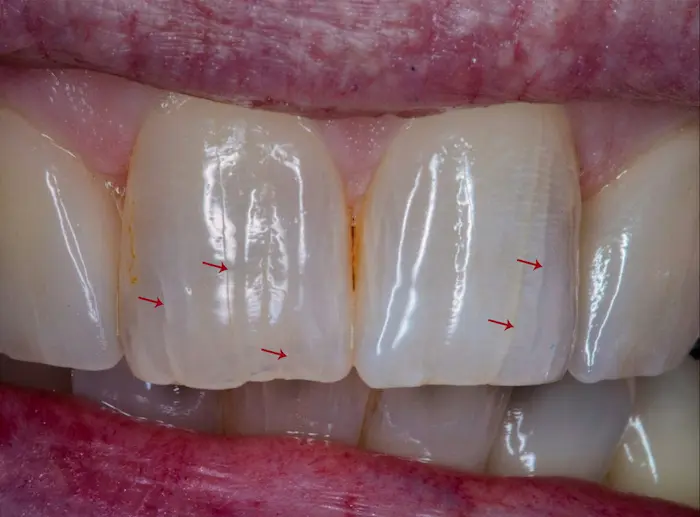 یک نمونه ترک خوردگی دندان جلو 15631