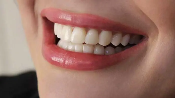 یک نمونه ترک خوردگی دندان های فرد بیمار15631