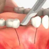 چرا جراحی لثه برای ایمپلنت دندان ضروری است؟⁉️| مراقبت های بعد از جراحی لثه☑️