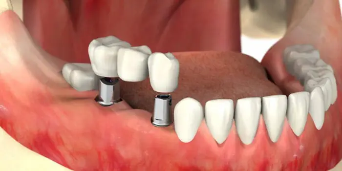 جراحی لثه برای ایمپلنت دندان های پایین 4354664