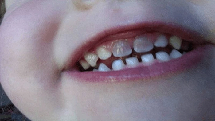 به وجود آمدن لکه بر روی دندان های جلویی یک کودک 543463786