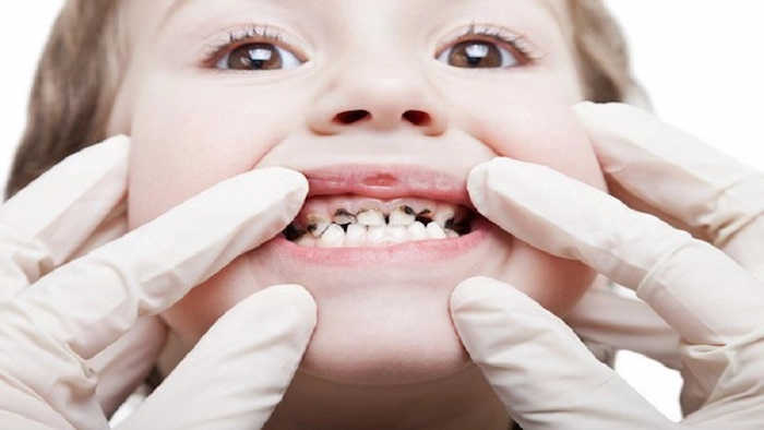 معاینه کردن پزشک از دندان های سیاه شده یک کودک 145347746674
