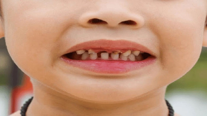 سیاه شدن دندان یک کودک 41587438