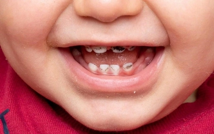 سیاه شدن دندان های یک کودک توسط قطره آهن 4156743687