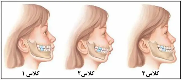 کلاس های شدت و خفیف بودن آندربایت بیمارها با فک های مختلف و سوال اینکه جراحی فک یا ارتودنسی؟ 475845476548763